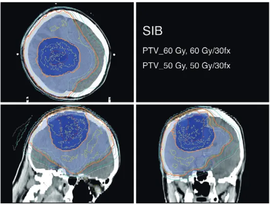 Fig. 4 VMAT plan for postoperative brain tumor 