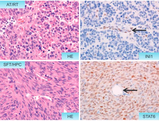 Fig. 4 Immunohistochemistry  as  a  surrogate  marker  for  genetic  aberrations.  Upper  panels:  a  case  of  AT/RT  involving  rhabdoid  cells  with  eosinophilic  intracytoplasmic  inclusions.  Loss  of  nuclear  immunoreactivity  for  INI1  is  a  dia