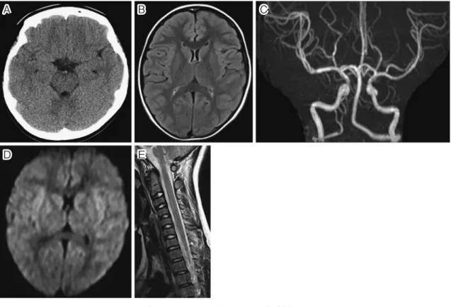 Fig. 1 Images taken on day 1 of illness All images show no abnormal findings. A) Simple CT of the head; B) simple FLAIR MRI of the head; C) simple MRA of the head; D) simple diffusion-weighted image MRI of the head; E) simple FLAIR MRI of the cervical vert