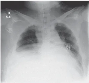 Fig. 2 Image of chest radiography on the 3rd day of  hospitalization