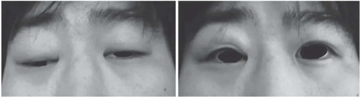 Fig. 3 The edrophonium test on the 19th day of hospitalization The ptosis was improved significantly after an edrophonium test. The picture on the left   is before performing the edrophonium test and the picture on the right is after edropho-nium injection