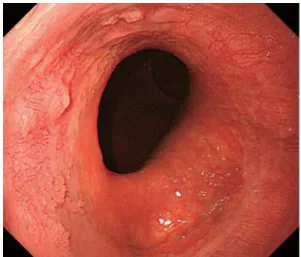 Fig. 5 Endoscopic  image  of  the  esophagogastric  junction 14 months after the start of treatment. The  lesion had further reduced.