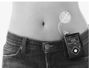 Fig. 6 Artificial pancreas (MiniMed 620 G, Medtronic  MiniMed, Inc) 13) 血糖コントロールが望まれるようになった． 糖尿病治療はめまぐるしい発展を遂げており，現 在では前述のとおり，インスリンによる血糖コント ロールだけでなく，移植という選択肢も拡がってき ている．臓器移植に関しては倫理的な問題からも， いまだ賛否両論さまざまな意見があるが，あらゆる 治療をもってしても管理に苦慮する症例では，生命 予後の改善， QOL の向上，合併症予防