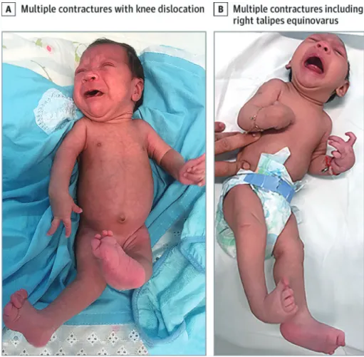 Fig. 1 Infants with congenital Zika infection, microcephaly, and arthrogryposis  A) Newborn infant with bilateral contractures of the hips and knees, bilateral talipes calca-neovalgus, and an anterior dislocation of the knees. The hips are bilaterally disl