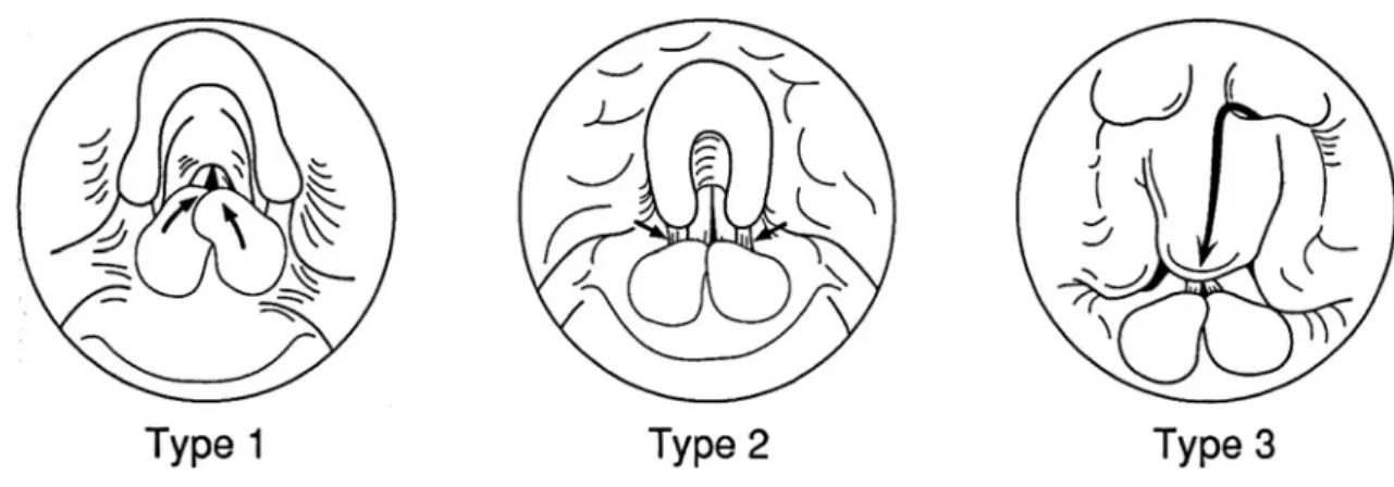 Fig. 1 Classification of laryngomalacia   Type 1, prolapse of mucosa overlying the arytenoid cartilages. Type 2, foreshortened ary-epiglottic folds. Type 3, posterior displacement of the epiglottis