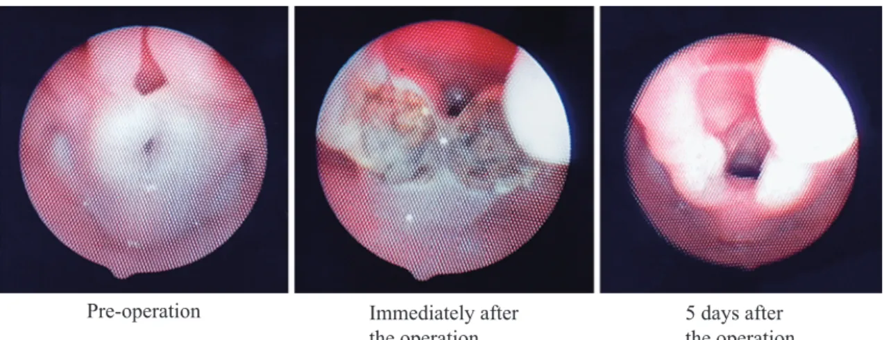 Fig. 3 Laser laryngoplasty for Type 2 laryngomalacia