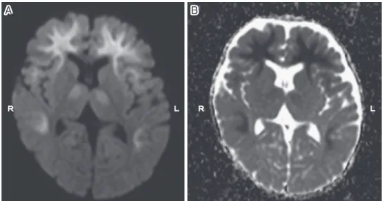 Fig. 1 Magnetic resonance image (MRI) of the brain in a patient with acute encephalopa- Fig. 1 Magnetic resonance image (MRI) of the brain in a patient with acute encephalopa-thy with biphasic seizures and late reduced diffusion (AESD) on the fifth day of 