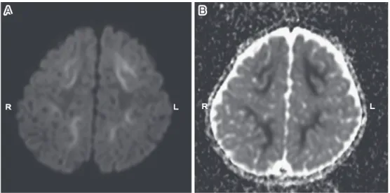 Fig. 2 MRI  of  the  brain  in  a  patient  with  acute  encephalopathy  with  biphasic  seizures  and late reduced diffusion (AESD) on the fifth day of illness (case 2)  A: DWI showed high signal lesions in the subcortical white matter with reduced diffu-