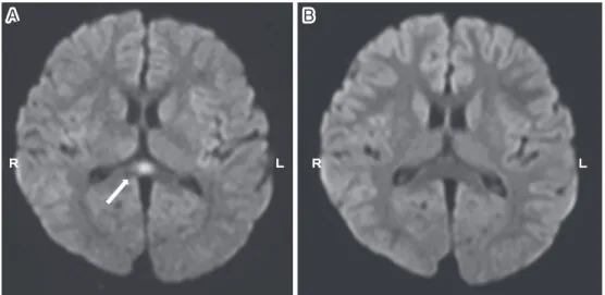 Fig. 3 MRI of the brain in a patient with mild encephalopathy with a reversible splenial  lesion (MERS)