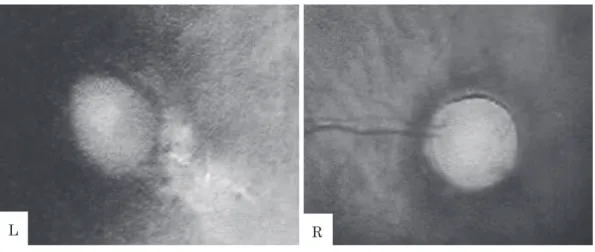Fig. 1 Ophthalmological examination of the patient Both eyes present with the optic nerve coloboma.
