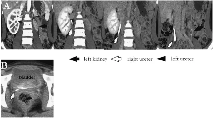 Fig. 1 Enhanced computed tomography (CT) scan A: Enhanced CT scan showing a left hypoplastic kidney and a compensatory hypertrophic  right kidney