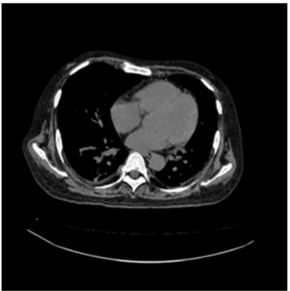 図 2.2: 人体胸部付近の CT 画像．人体胸部付近をグレースケールで表示している．白は より高い CT 値である．