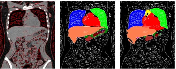 図 3.1: 肝臓が上手くセグメンテーションされていない例. 左は CT 画像，中央は Ground Truth，右はデータ項，アトラス項，平滑化項の三つだけを用いたセグメンテーション結 果を示す． CT 画像内の赤線および Ground Truth とセグメンテーション結果の白線が エッジを示す．肌色が肝臓，赤色が心臓を示す．セグメンテーション結果では肝臓左葉 部分が上手くセグメンテーション出来ていない． 高階ポテンシャルを用いた場合，前章の (2.12) 式は