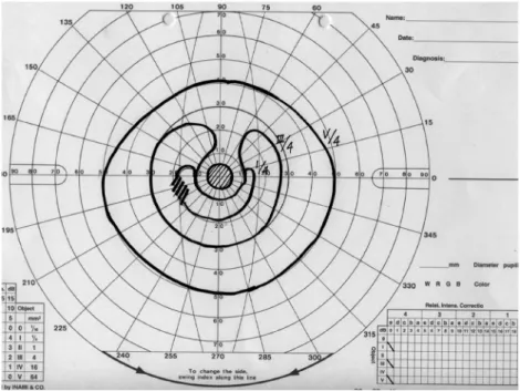 Figure 3. The left eye s visual field of this case. It shows the central scotoma but visual acuity was 0.1, suggesting that there  might be a very small high sensitivity area inside the central scotoma.