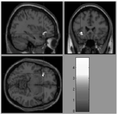 Figure 3. Activation of OFC  （Orbitofrontal cortex）．
