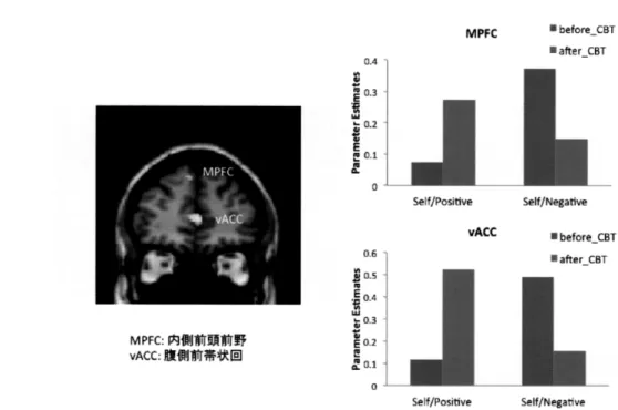 Figure 　 2 ． 　 Changes 　 ofbrain 　 activity 　 between 　 before 　 and 　 after 　 CBT ．