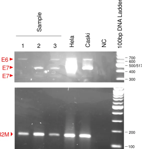Fig 4. Detection of E6/E7 mRNAs from patients. E6 transcript is detected in samples 1 and 3, and 2 kinds of E7