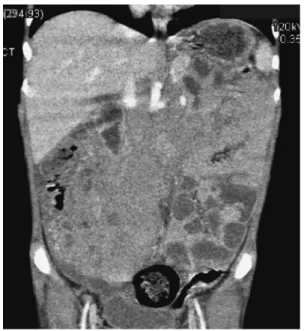 Fig. 2 Abdominal CT findings (case 4) A  bulky  mass  (maximum  diameter,  20.0  cm)  arising  from the terminal ileum is visible