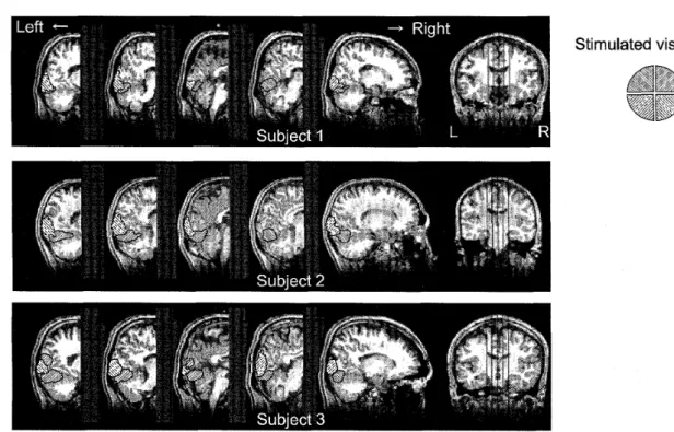Figure 4. The results of fMRI measurernent. The figure shows the retinotopic area in 5 slices of the