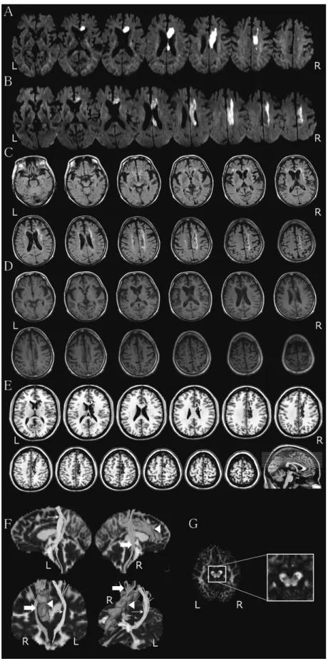 図 1  発症時と梗塞巣拡大時の拡散強調画像と FLAIR 像および T1 強調画像と空間的 標準化後の病巣の mapping，拡散テンソルトラクトグラフィー所見と FA 画像 A ：拡散強調画像（発症時） B ：拡散強調画像（梗塞巣拡大が確認された 28 病日） C ：FLAIR 画像 D ：T1 強調画像