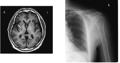 図 1 外来開始時の頭部 MRI（左）と左肩関節（右）単純エックス線所見 当院外来移行後の画像所見である．左は頭部 MRI 像（T1 強調画像）であり，内包後脚の病変 は認めるものの（矢印），視床病変は認めなかった．右は左肩関節の単純エックス線像で，亜 脱臼や腱板断裂，骨棘の形成などの変形性関節症の変化をうかがわせる所見は認めなかった． 表 1 初期，6 ヵ月，12 ヵ月後の各評価項目の結果 評価項目 開始時 6 ヵ月後 12 ヵ月後 疼痛 NRS 8 0 0 部位 右肩〜上腕 − − 表現 ジンジン・ズー