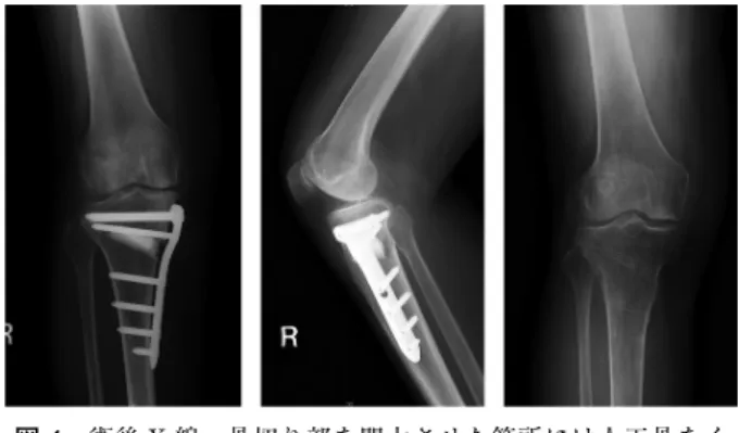 図 3  Open  wedge  osteotomy の骨切りラインの模式図．側 面像では脛骨結節を厚さ 1 cm 程度残した bi-plane で 骨切りを行う（右）．