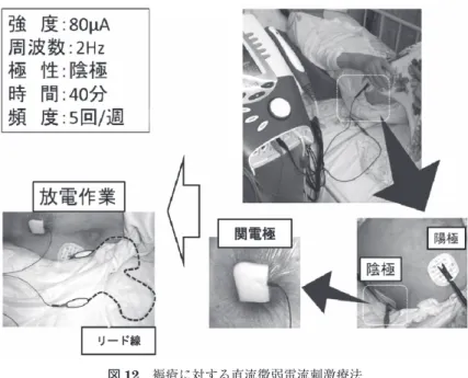 図 12 褥瘡に対する直流微弱電流刺激療法