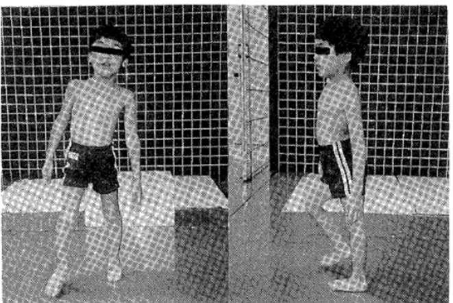 Fig. 1. Pattern of walking in children with spastic             spinaE paraplegia. Lordosis is remarkable             and compensatory sideflexion of trunk is             observed when he shifts his weight to one             leg.