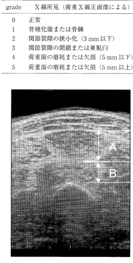 図 1 　超 音 波 断 層 撮影 に よ る 大 腿 四 頭 筋 横 断 面 像 　 　 　 　 　 　 A ： 大腿 直 筋 　 　 　 　 　 　 B ： 中 間 広 筋 し た 9 〕 （ 表 1 ）。 FTA の 計 測 な らび に 重 症 度 の 判 定 に は 熟 練 し た 整 形 外 科 医 師 ユ 名 が 担 当 し た 。 さ ら に 超 音 波 断 層 撮 影 装 置 を 用 い 大 腿 四 頭 筋 の 水 平 断像 か ら 筋厚 を 測 定 し た 。 断 層 撮 影 に は 超
