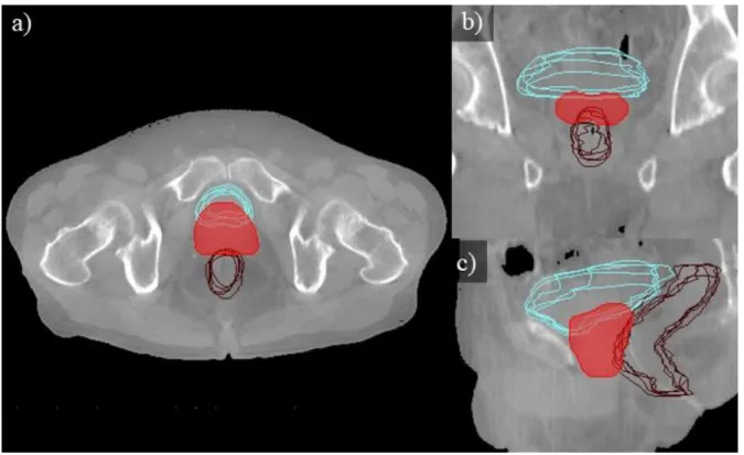 Fig.  1.2  A  visualization  of  the  interfractional  shape  variations  of  rectum  (magenta  contour)  and  bladder (cyan contour) with respect to the PTV (red contour), as delineated by radiation oncologists: 