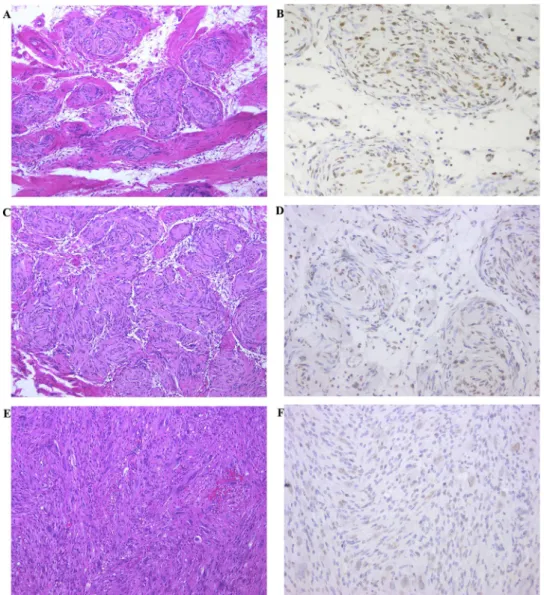 Fig. 5. The case of MPNST arising from plexiform neuroﬁbroma. The component of low-grade malignancy (a,b) showed a proliferation of spindle-shaped cells arranged in whorl pattern, having the feature of plexiform neuroﬁbroma