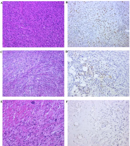 Fig. 4. The recurrent case of MPNST (case 3, Table 3). As the recurrence was repeated, the tumor showed severer nuclear atypia, more pleomorphism and more frequent atypical mitosis, so obtained higher malignancy