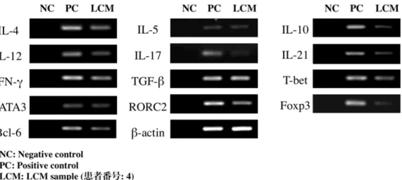 図 2c    SS  患者において   LCM  を行った組織におけるサイトカイ ン、転写因子の  mRNA  の増幅産物