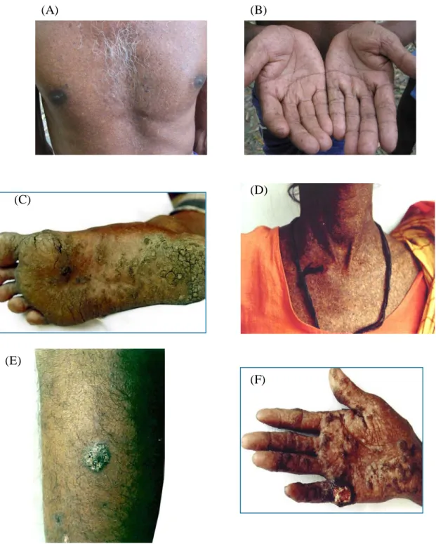 Figure 1.2 Photographs of the arsenicosis patients: (A) Melanosis, (B) Keratosis in  palm, (C) keratosis in foot, (D) Severe melanosis, (E) Bowens, and (F) Cancer 