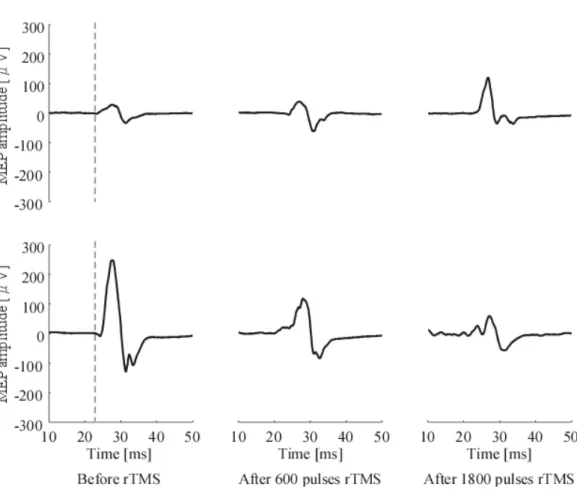 Figure 2.4 Example MEP waveforms after applying 85% RMT rTMS. The upper  waveforms are from a subject whose MEP before rTMS showed early latency and a small  amplitude, and was little affected by the 1 Hz rTMS