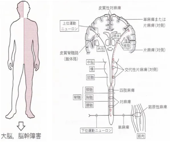 図 5 （左）片麻痺の状態像と（右）上位ニューロンの障害部位と麻痺の状態 