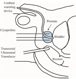Figure 0.5 A schematic of multi-probe cryosurgery for the prostate cancer [24]. 