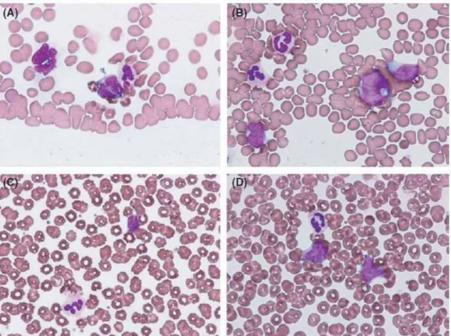Figure 1 Abnormal lymphocytes in peripheral blood smears 