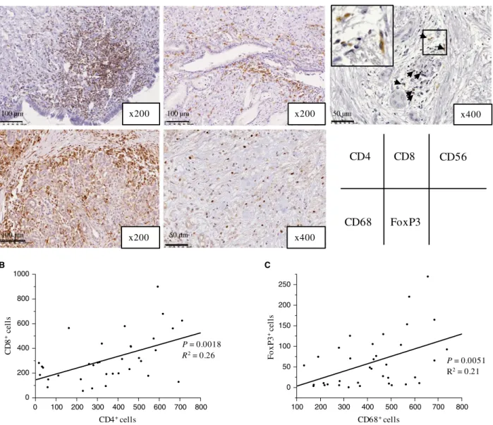 Figure 2. HLA expression and the association between HLA expression and immune cell infiltrates in primary PDA lesions