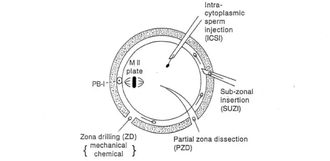 Table  5.  Chronological  overview  on  the  IVF  by  sperm  microinjection 1962===  1966=  _  _  1976-77  =  1986 =  =  =  1987===  1991=  =  =  1993===  Since  1990  Since  1994
