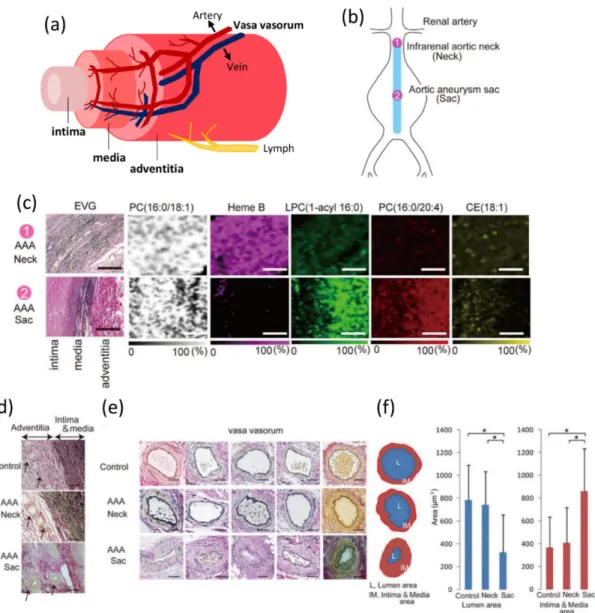 Figure 2 Structure of aortic wall, and the stenosis of adventitial vasa vasorum (VV) in AAA  wall