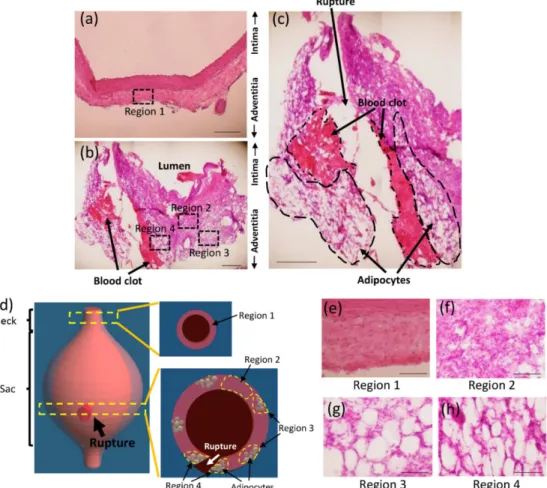 Figure  12  Histological  analyses  of  the  ruptured  AAA  wall.  Representative  images  of  AAA  neck wall (a) and sac wall (b)