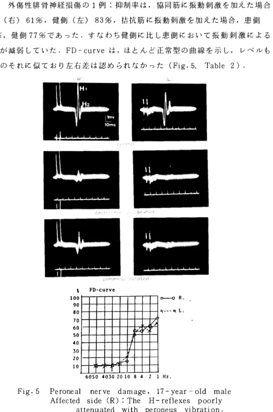 Fig.  5   Pe  rone  al   nerve   damage   ,   17-  year  -  old  male  Affected  side  (R)  :  The  H-  reflexes  poorly 
