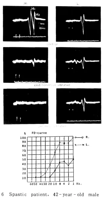 Fig.  6   Spastic  patient,   42   -   year   -   old  male 
