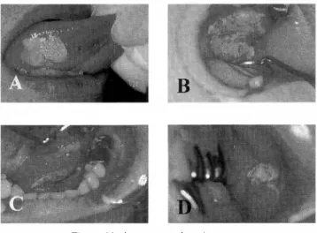 Fig.  1.  Various  type  of  oral  cancer. 