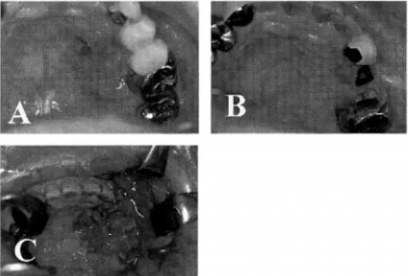 Fig.  2.  Typical  mandibular  marginal  resection. 