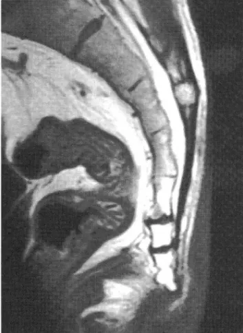 Fig.  1  MRI  showing  the  coccygeal  retroversion. 
