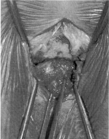 Fig.  2  Tip  of  the  coccyx  retroverted  like  a  rhino  horn  found  in  the  operation
