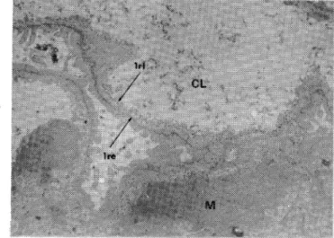 Fig. 2  Isolated  hematuria.  PEI  particles  indicating  charged  sites  on  both  laminae rarae and in the mesangium