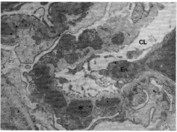 Fig. 4  Purpura  nephritis.  Electron  dense  deposits  in  the  mesangial  area  have  no  PEI  particles